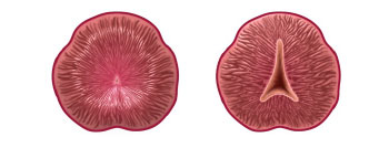 Before and after graphics of the reshaped prostate following treatment with the iTind device.