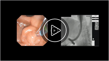 Play Video - Dr. Hasan Clinical Video