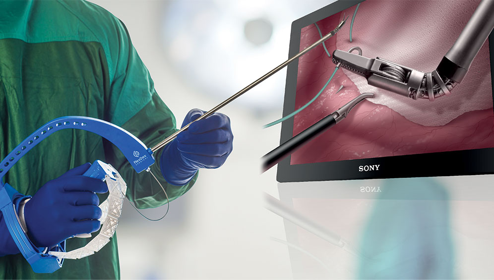 ENDOEYE FLEX 3D and FlexDex Olympus America Medical