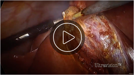 Cholecystectomy (Play Video)
