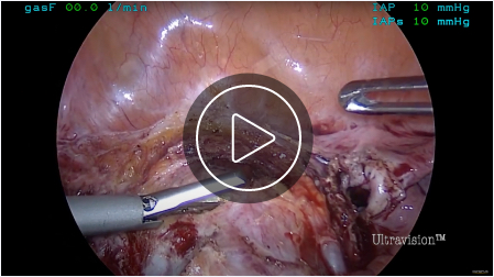 Hysterectomy (Play Video)