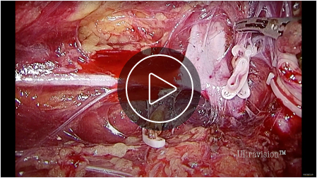 Retroperitoneal Nephrectomy (Play Video)